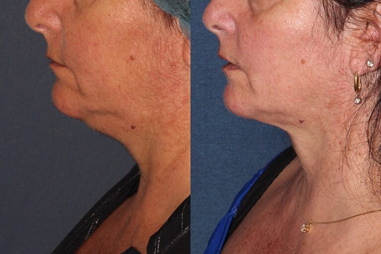 Before and after side image of ThermiTight treatment on a female's chin and neck performed by Dr. Wu at our San Diego medical spa