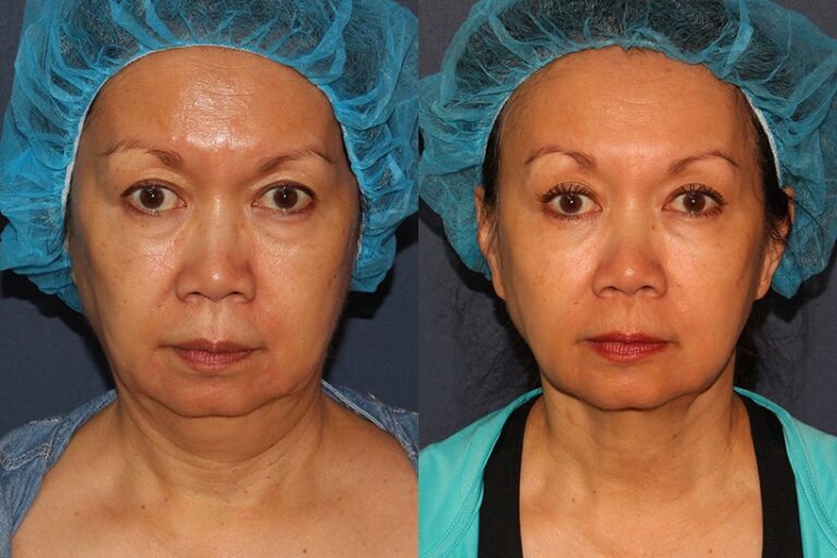 Before and after front image of ThermiTight treatment on a female's chin performed by Dr. Wu at our San Diego medical clinic