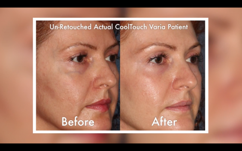 cooltouch results on a female patient from San Diego