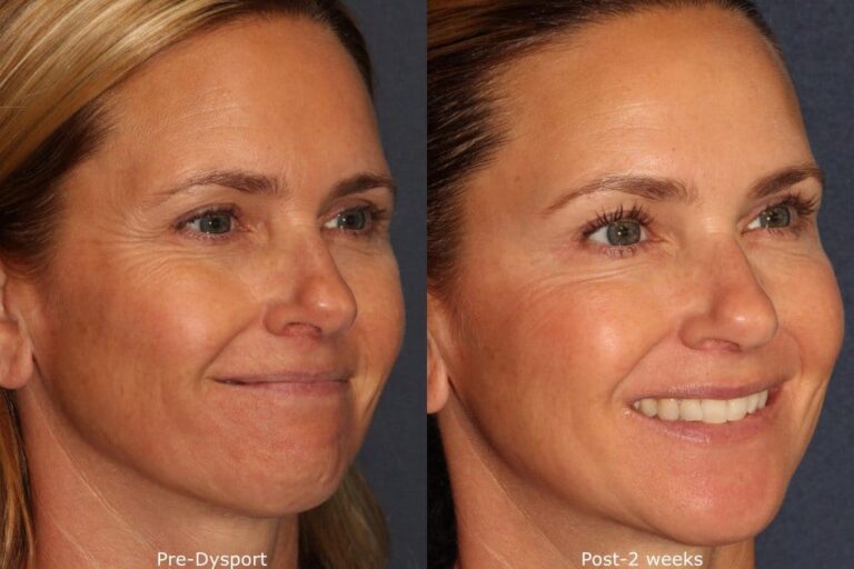 Before and after oblique image of Dysport treatment on a female's crow's feet performed by Dr. Wu at our San Diego medical spa
