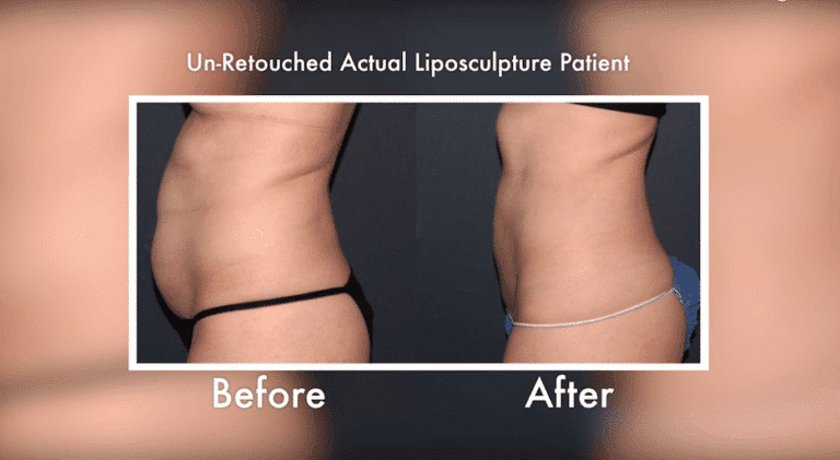 Before and after side image of liposculpture treatment on a female's abdomen performed by Dr. Wu at our San Diego medical spa