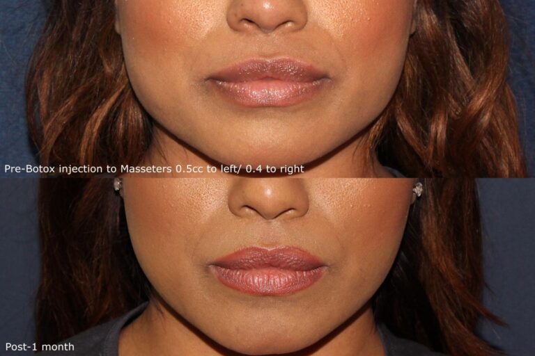 Before and after front image of Botox treatment on a female's masseter muscles performed by Dr. Fabi at our San Diego medical spa