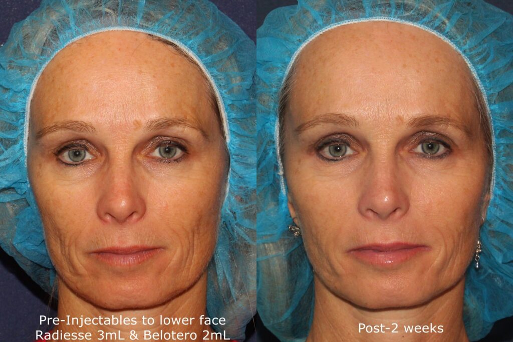 Radiesse Dermal Filler Medi Spa San Diego CA CLDerm