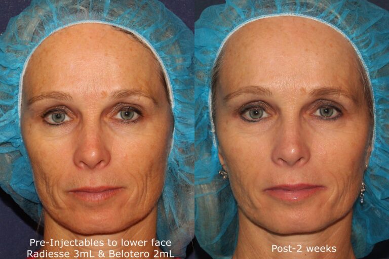 Before and after front image of Radiesse and Belotero treatment on a female's face performed by Dr. Fabi at our San Diego medical spa