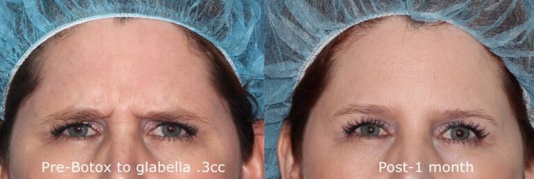 Before and after front image of Botox treatment on a female's glabellar lines performed by Dr. Fabi at our San Diego medical spa
