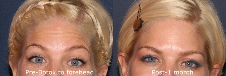 Before and after front image of Botox treatment on a female's forehead lines performed by Dr. Fabi at our San Diego medical spa