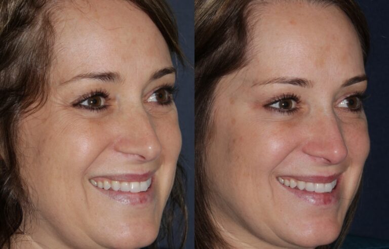 Before and after oblique image of Dysport treatment on a female's crow's feet performed by Dr. Fabi at our San Diego medical spa