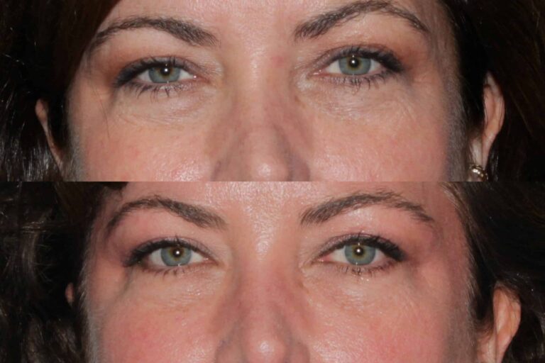 Before and after front image of Restylane treatment on a female's dark circles under the eyes performed by Dr. Fabi at our San Diego medical clinic