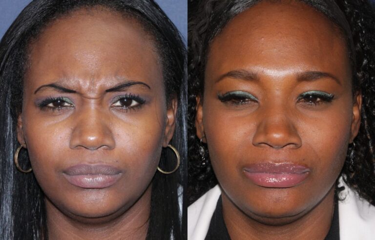 Before and after front image of Botox treatment on a female's glabellar lines performed by Dr. Fabi at our San Diego medical spa