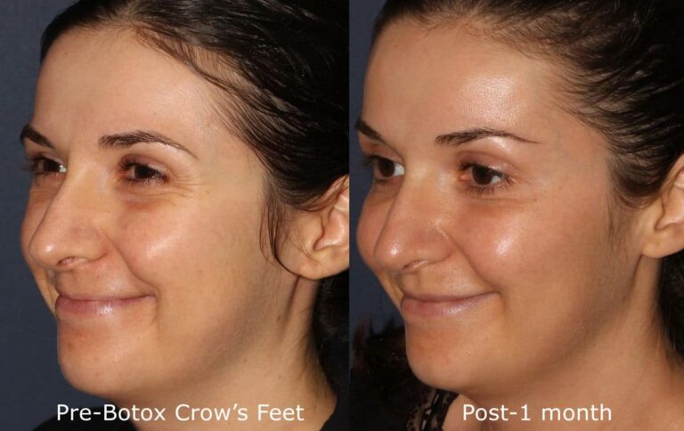 Before and after oblique image of Botox treatment on a female's crow's feet performed by Dr. Fabi at our San Diego medical spa