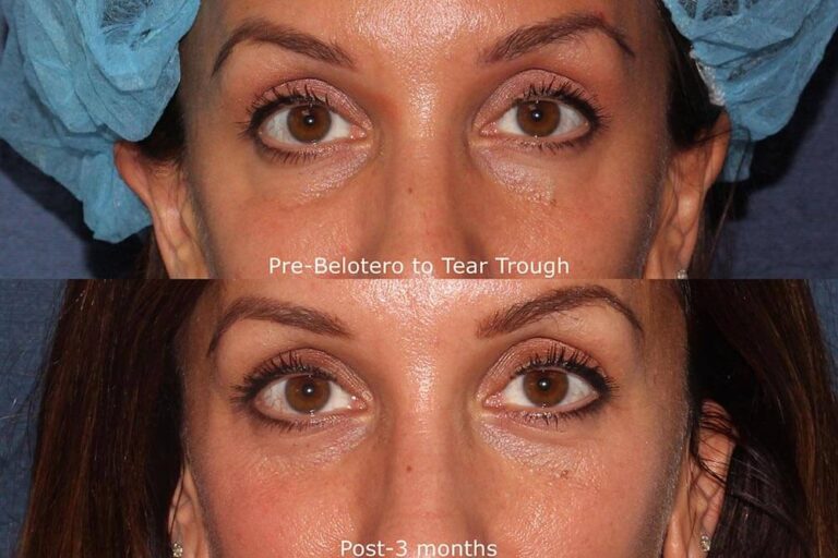 Before and after front image of Belotero treatment on a female's hollows under the eyes performed by Dr. Fabi at our San Diego medical spa