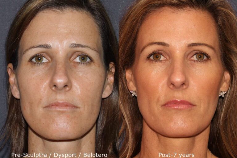 Before and after front image of Sculptra, Dysport, and Belotero treatment on a female's face performed by Dr. Fabi at our San Diego medi spa