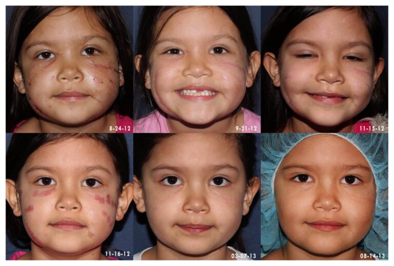 Before and after front image of a laser treatment on a female's face to treat a dog bite scar performed by Dr. Goldman at our San Diego medical spa