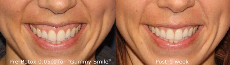 Before and after front image of Botox treatment on a female's gummy smile performed by Dr. Groff at our San Diego medical spa
