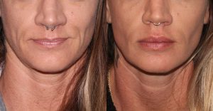 Before and after front image of Voluma treatment on a female's lips performed by Dr. Groff at our San Diego medical spa