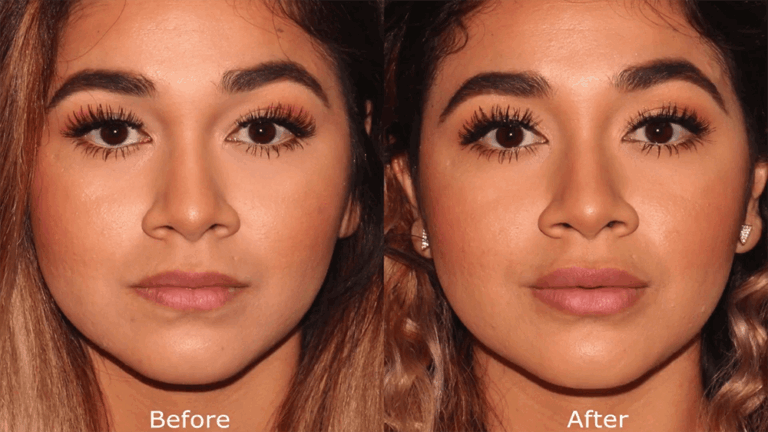 Before and after front image of dermal filler treatment on a female's lips performed by Dr. Butterwick at our San Diego medical spa