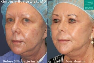 Before and after Silhouette InstaLift to rejuvenate the appearance by Dr. Butterwick. After treatment, skin and tissue is visibly lifted and patient looks more youthful, San Diego, CA.
