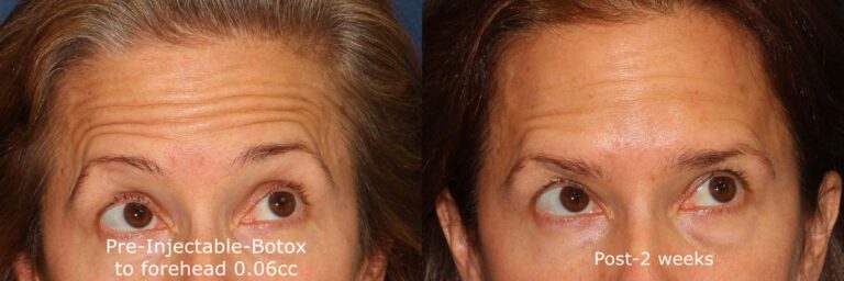 Before and after front image of Botox treatment on a female's forehead lines performed by Dr. Wu at our San Diego medical clinic