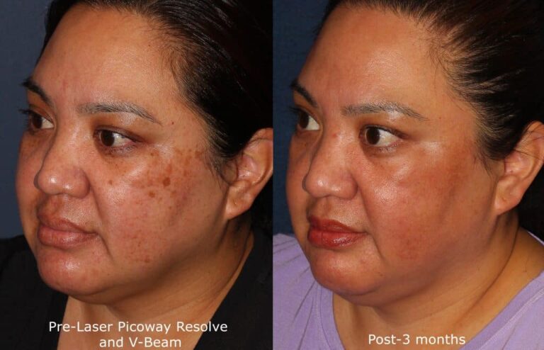 Before and after oblique image of PicoWay laser treatment on a female's face performed by Dr. Wu at our San Diego medical spa
