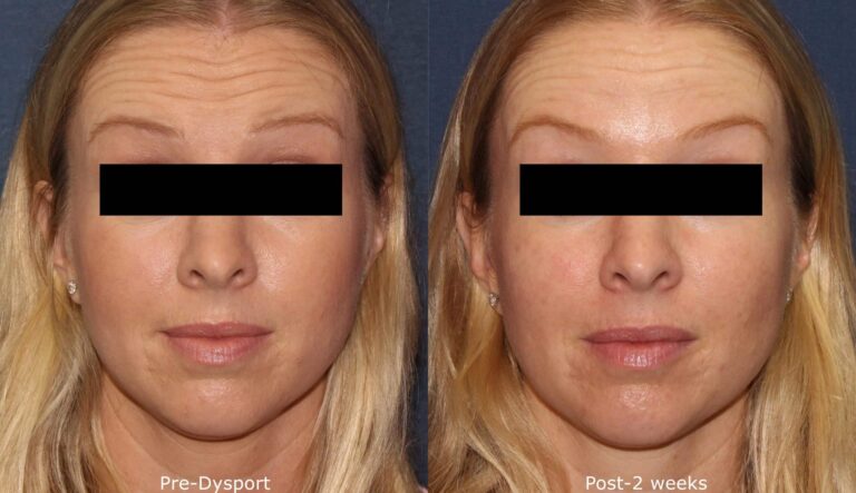 Before and after front image of Dysport treatment on a female's forehead lines performed by Dr. Wu at our San Diego medical spa