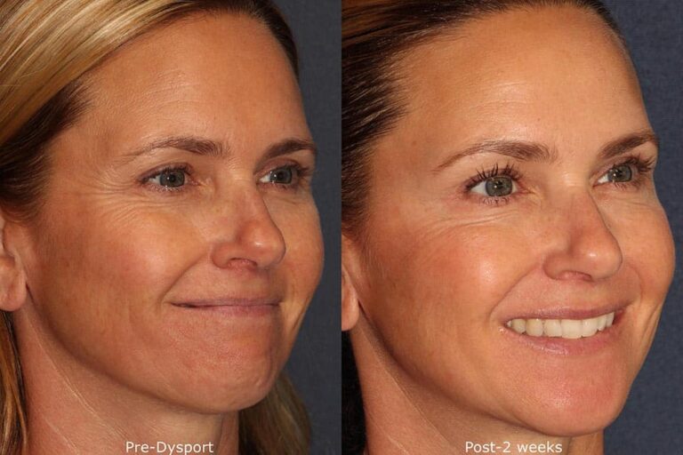 Before and after oblique image of Dysport treatment on a female's crow's feet performed by Dr. Wu at our San Diego medical spa