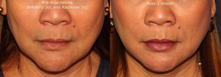 Before and after front image of Belotero and Radiesse treatment on a female's lower face performed by Dr. Butterwick at our San Diego medical spa