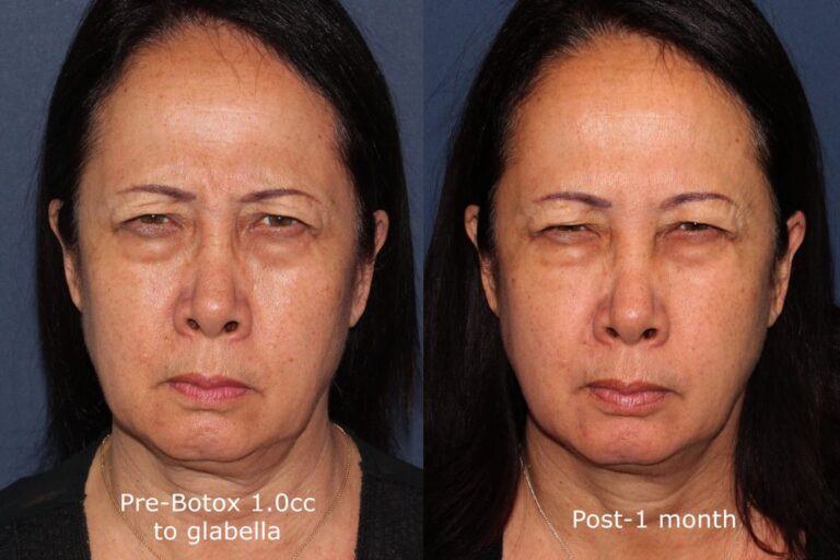 Before and after front image of Botox treatment on a female's glabellar lines performed by Dr. Butterwick at our San Diego medical clinic