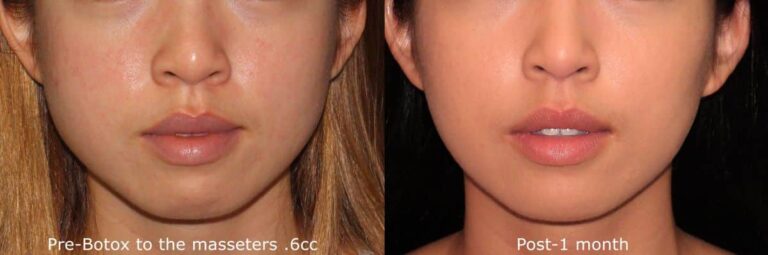 Before and after front image of Botox treatment on a female's masseter muscles performed by Dr. Butterwick at our San Diego medical spa