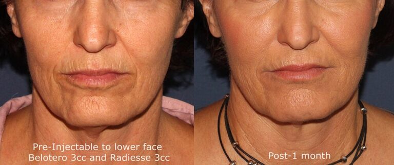 Before and after front image of Radiesse and Belotero treatment on a female's lower face performed by Dr. Butterwick at our San Diego medical spa
