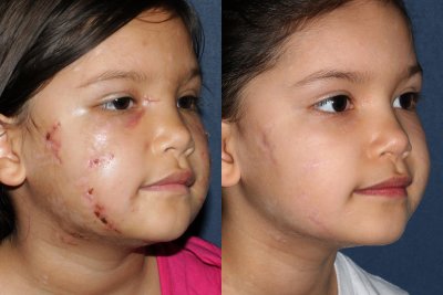 charitable scar treatment results in San Diego, CA