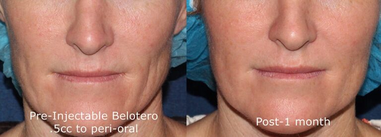 Before and after front image of Belotero treatment on a female's perioral lines performed by Dr. Fabi at our San Diego medical spa