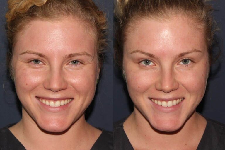 Before and after front image of Botox treatment on a female's brow line performed by Dr. Fabi at our San Diego medical clinic