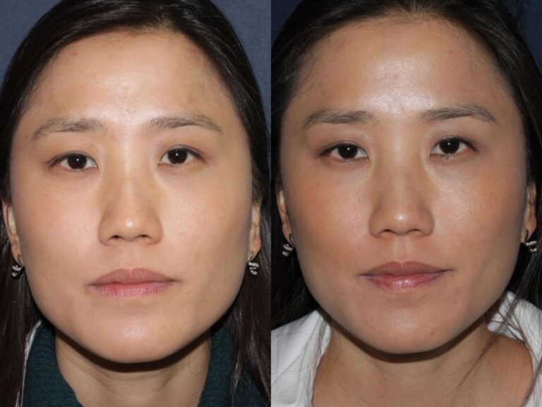 Before and after front image of Botox treatment on a female's masseter muscles performed by Dr. Fabi at our San Diego medical spa