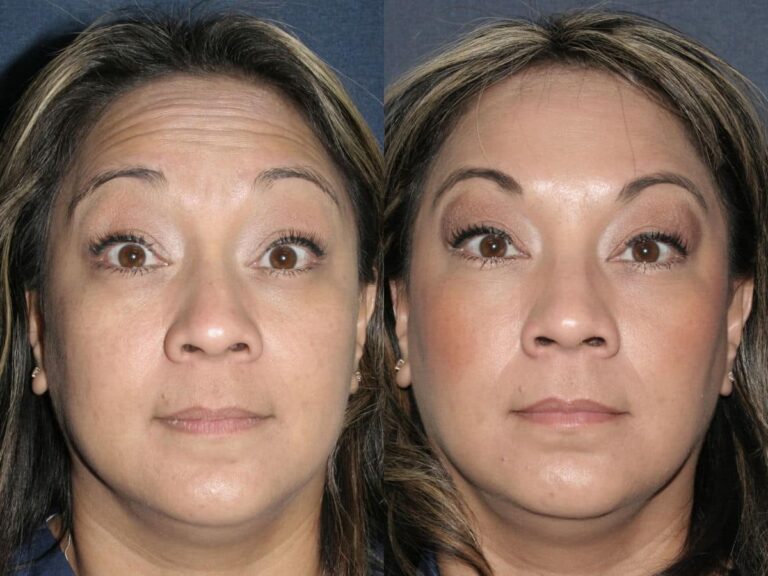 Before and after front image of Botox treatment on a female's forehead lines performed by Dr. Fabi at our San Diego medical clinic