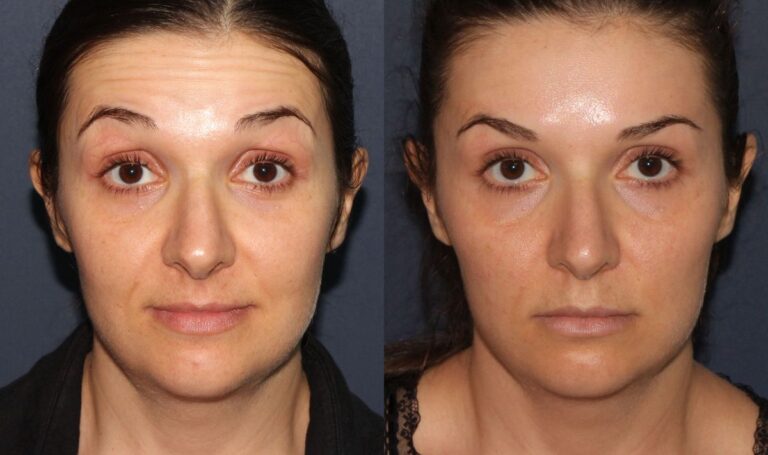 Before and after front image of Botox treatment on a female's forehead lines performed by Dr. Fabi at our San Diego medical clinic