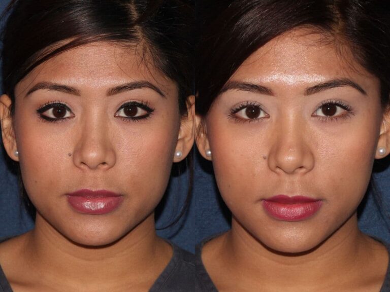 Before and after front image of Botox treatment on a female's masseter muscles performed by Dr. Fabi at our San Diego medical spa