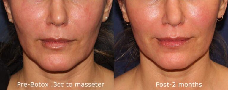 Before and after front image of Botox treatment on a female's masseter muscles performed by Dr. Fabi at our San Diego medical clinic
