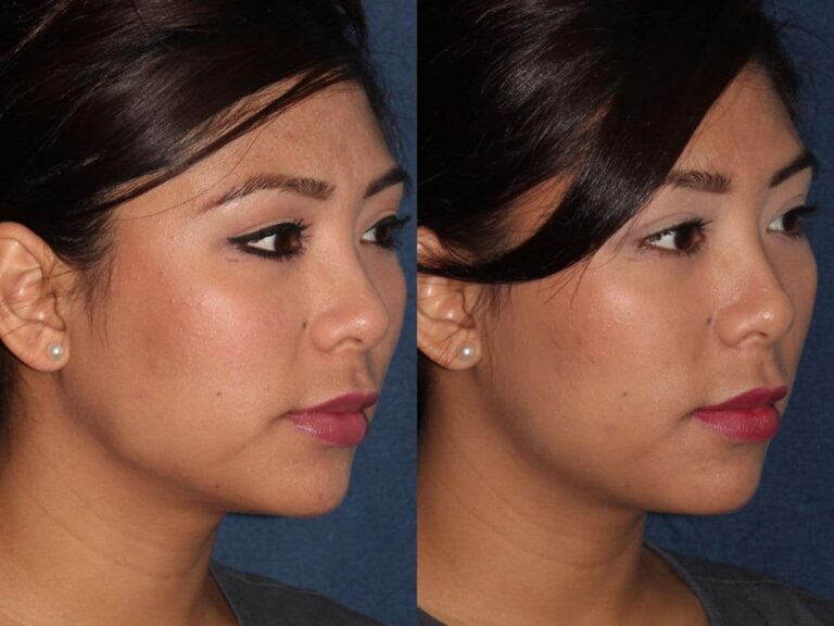 Before and after oblique image of Botox treatment on a female's masseter muscles performed by Dr. Fabi at our San Diego medical spa