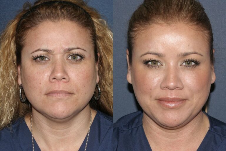 Before and after front image of Botox treatment on a female's glabellar lines performed by Dr. Fabi at our San Diego medical spa