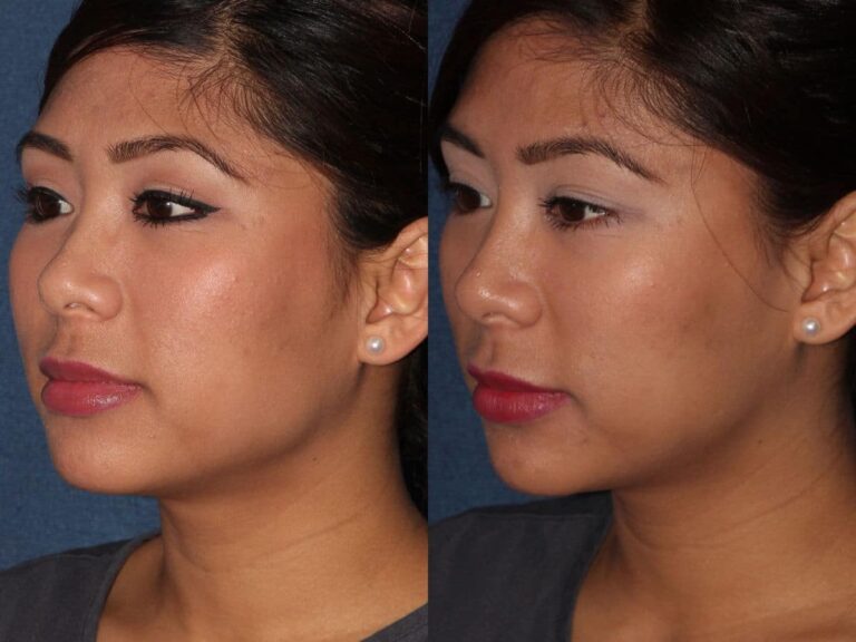 Before and after oblique image of Botox treatment on a female's masseter muscles performed by Dr. Fabi at our San Diego medical spa