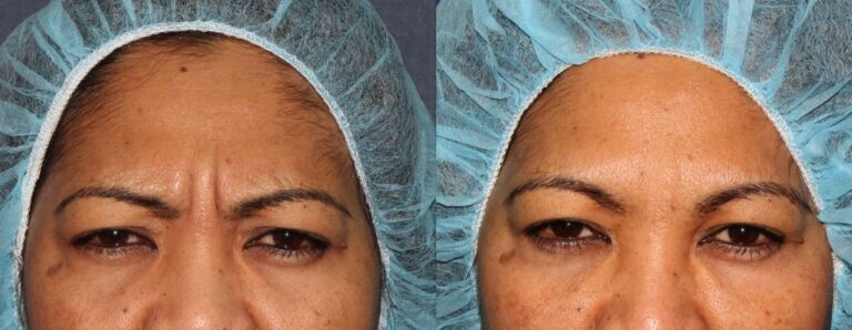 Before and after front image of Botox treatment on a female's glabellar lines performed by Dr. Fabi at our San Diego medical clinic