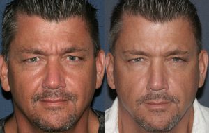 Before and after image of Botox Treatment by Cosmetic Laser Dermatology in San Diego