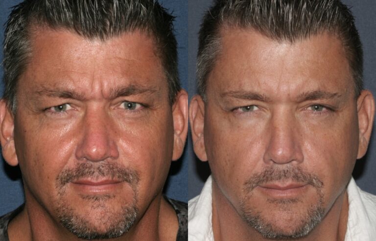 Before and after front image of Botox treatment on a male's glabellar lines performed by Dr. Fabi at our San Diego medical spa