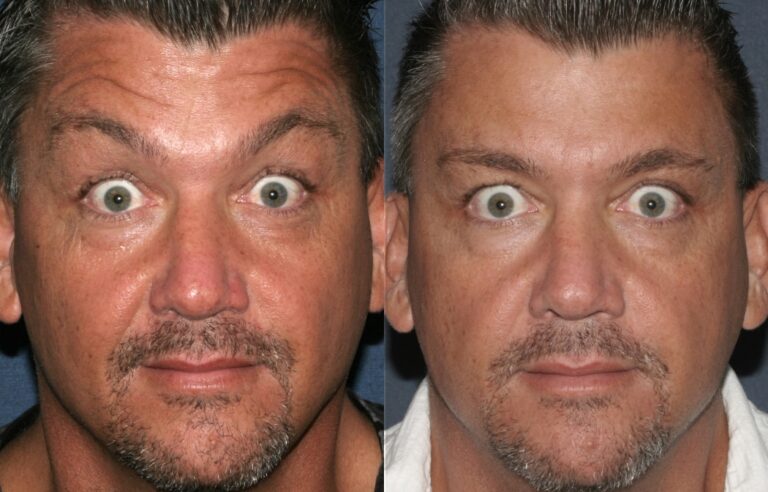 Before and after front image of Botox treatment on a male's forehead lines performed by Dr. Fabi at our San Diego medical spa