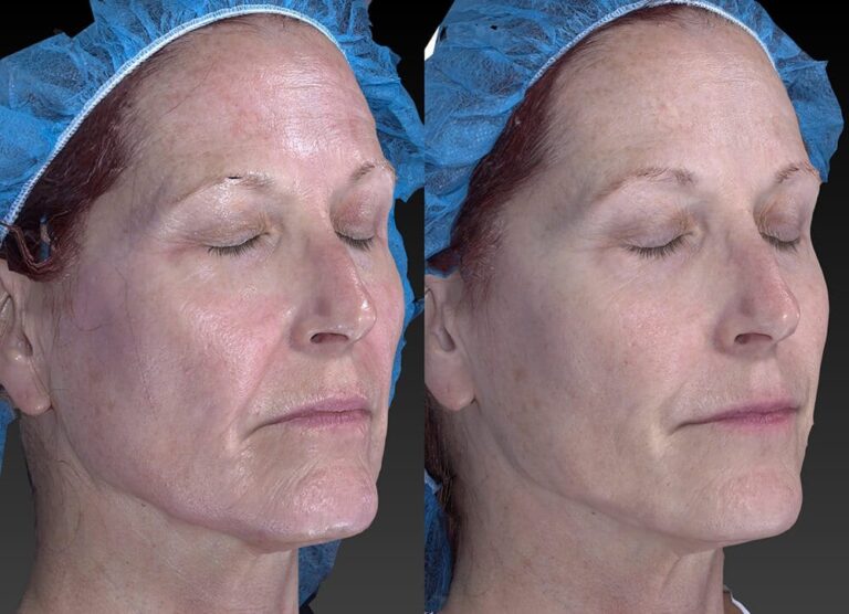 Before and after oblique image of Radiesse, Belotero and Sculptra treatment on a female's face performed by Dr. Fabi at our San Diego medical spa