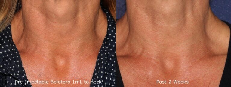 Before and after front image of Belotero treatment on a female's neck performed by Dr. Fabi at our San Diego medical spa
