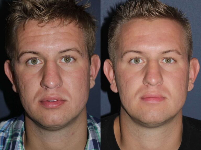Before and after front image of LaViv filler treatment on a male's smile lines performed by Dr. Fabi at our San Diego medical clinic