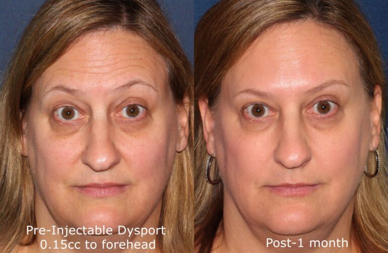 Before and after front image of Dysport treatment on a female's forehead lines performed by Dr. Fabi at our San Diego medical spa