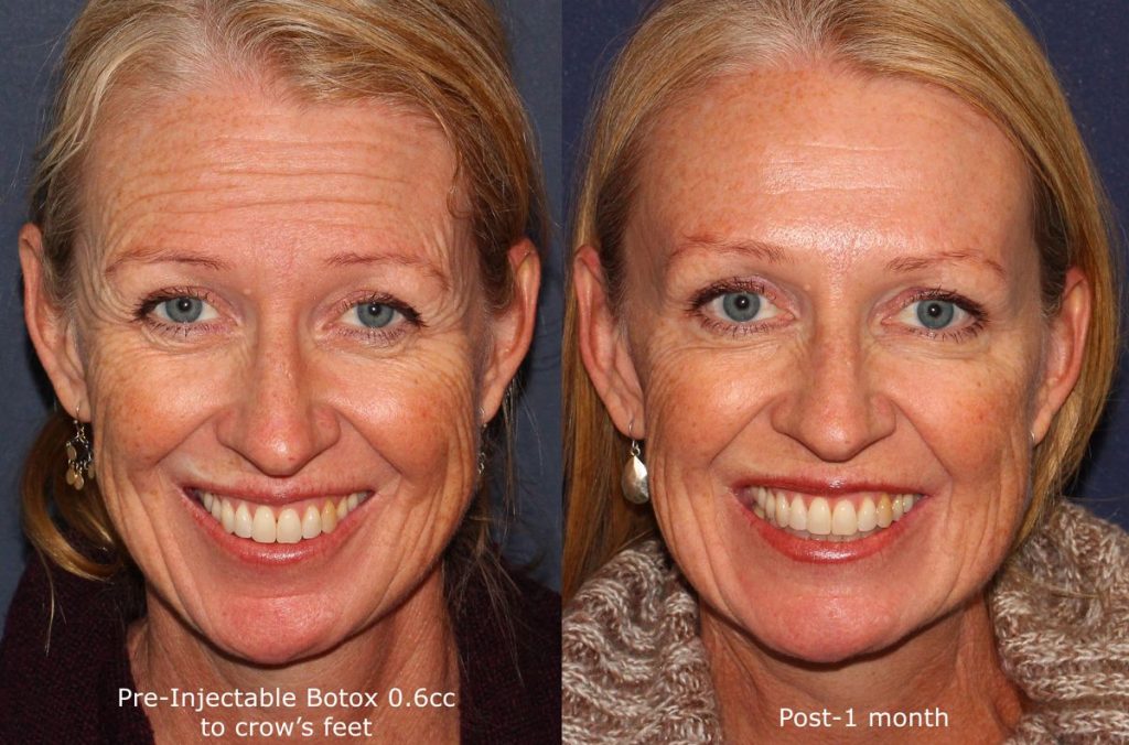 cosmetic laser dermatology Before and after Botox treatment on a female's forehead lines performed by Dr. Fabi san Diego CA