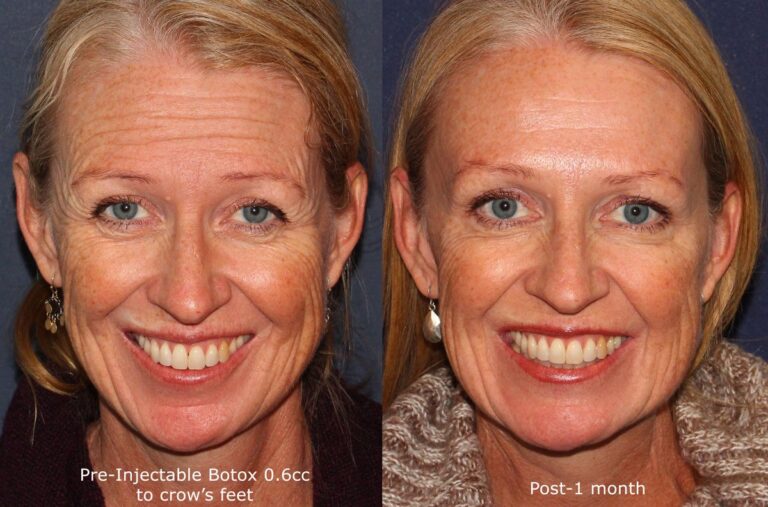 Before and after front image of Botox treatment on a female's forehead lines performed by Dr. Fabi at our San Diego medical clinic